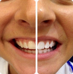 Teeth Whitening Frequently Asked Questions | PureSmile